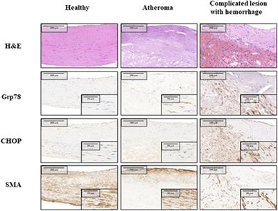 Heme Induces Endoplasmic Reticulum Stress (HIER Stress) in Human Aortic Smooth Muscle Cells